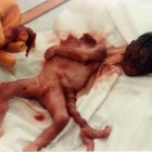 aborto